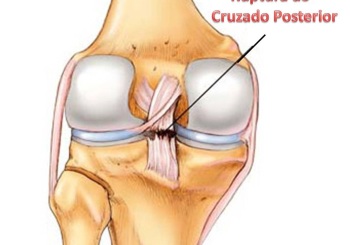 Ligamento Cruzado Posterior